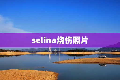 selina烧伤照片